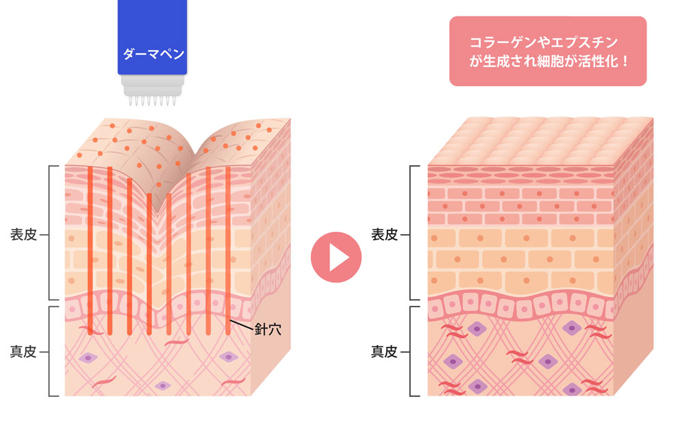 ダーマペンの仕組み