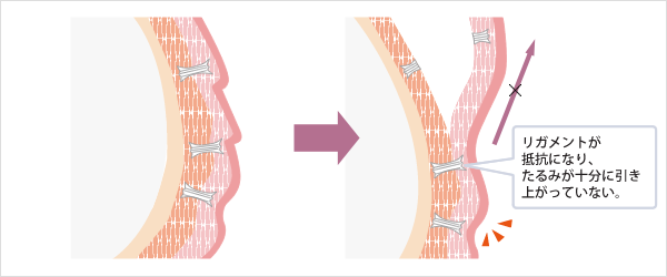 皮膚の引き上げ、靭帯（リガメント）の処理