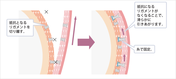 皮膚の引き上げ、靭帯（リガメント）の処理