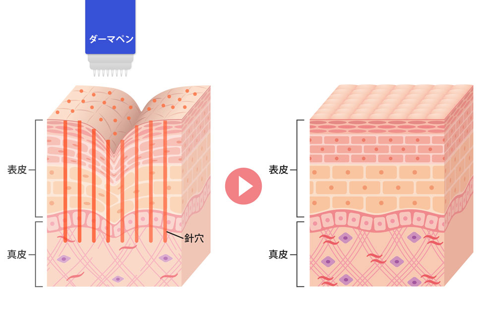 ダーマペンの仕組み