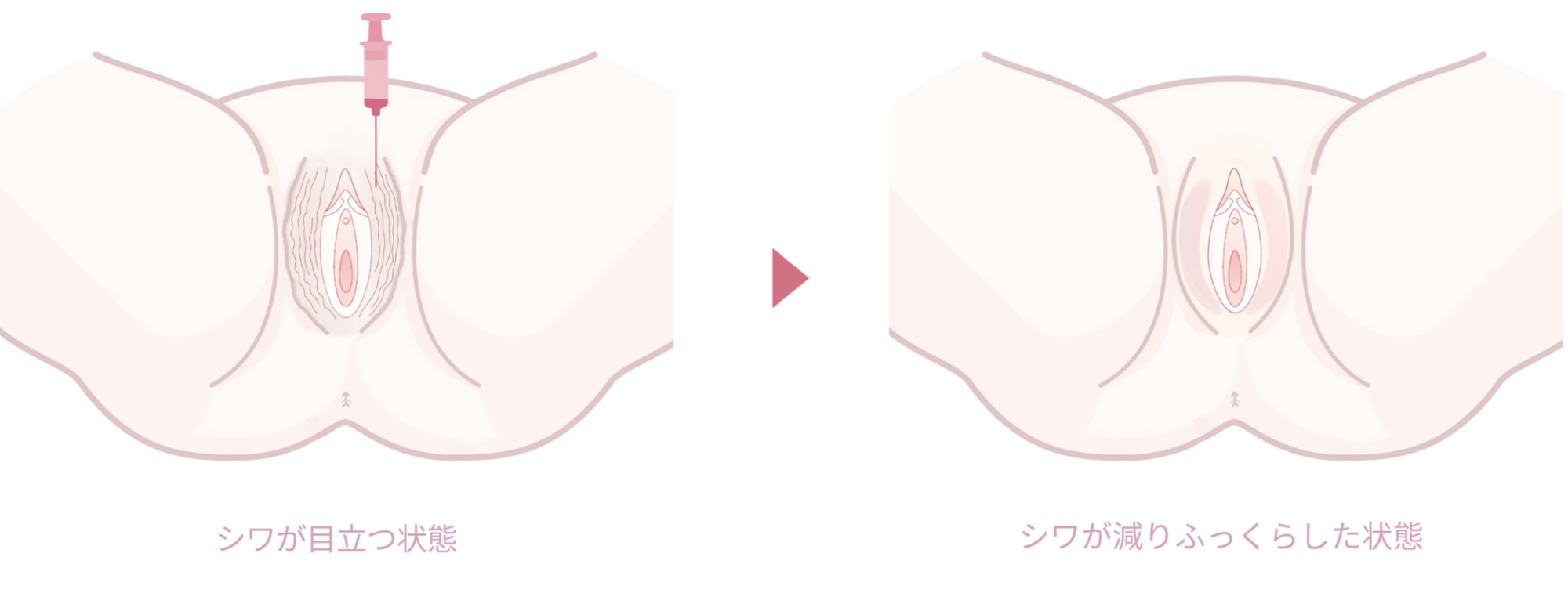 大陰唇ヒアルロン酸注入 ビフォーアフター