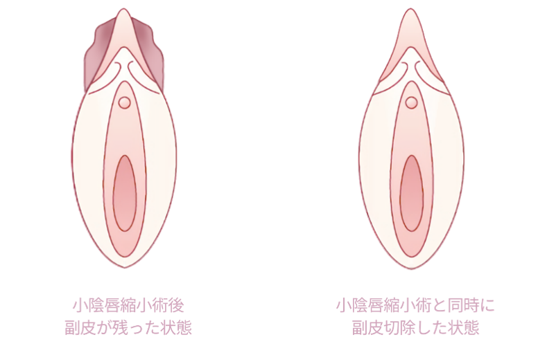 副皮切除術 ビフォーアフター