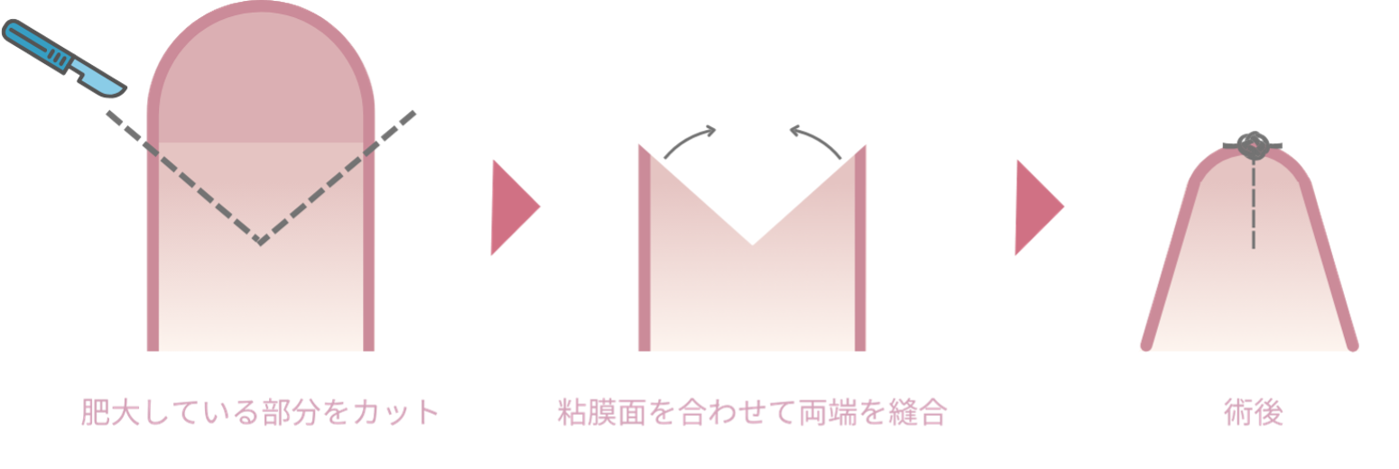 女性器形成