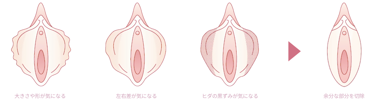 婦人科形成手術の適応